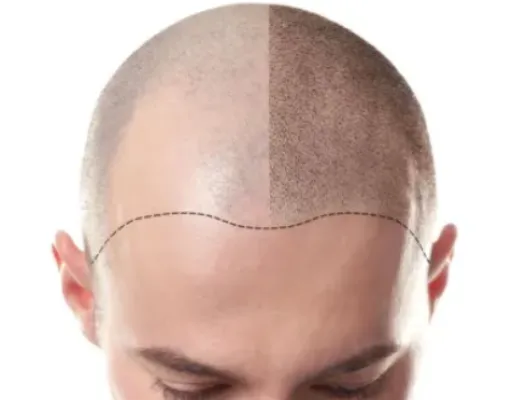 Profitez du rabais micropigmentation capillaire pour une transformation capillaire rapide et efficace