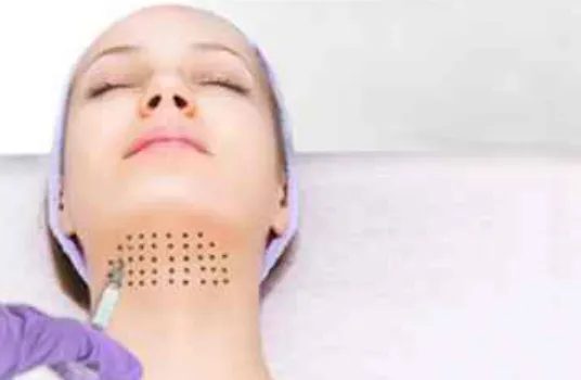 traitement RF/Microneedling : Rajeunissement de la peau avec microneedling.